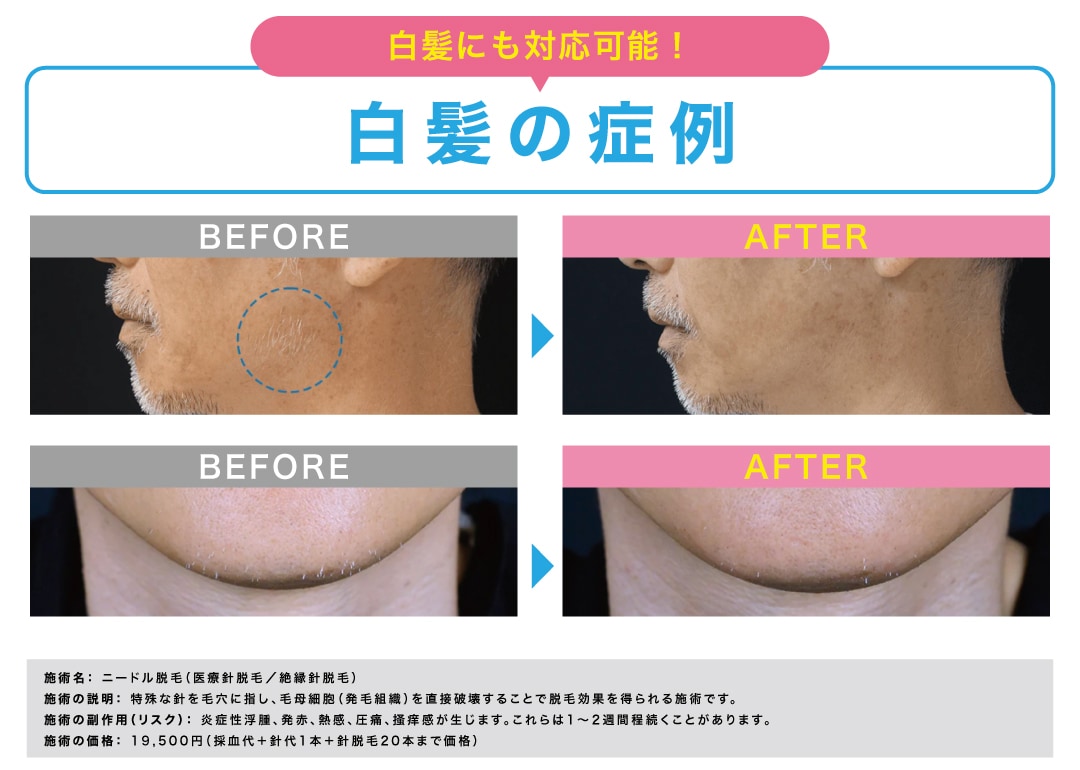 白髪にも対応可能✨ 白髪の症例