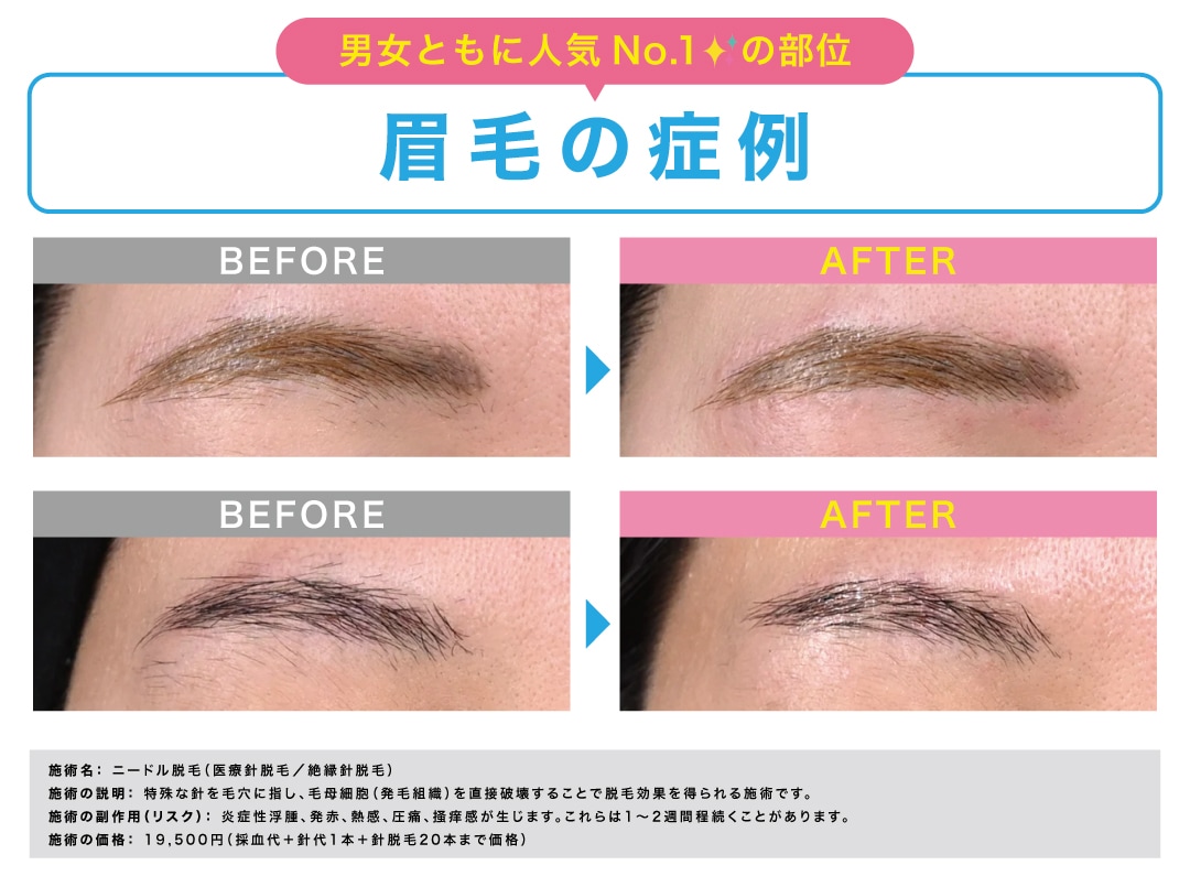 男女ともに人気No.1 ✨ 眉毛の症例