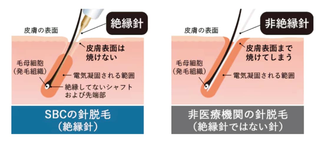 絶縁針とは？
