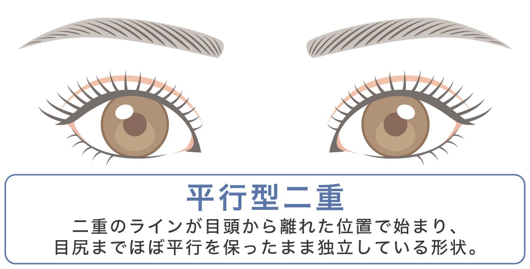 平行型二重