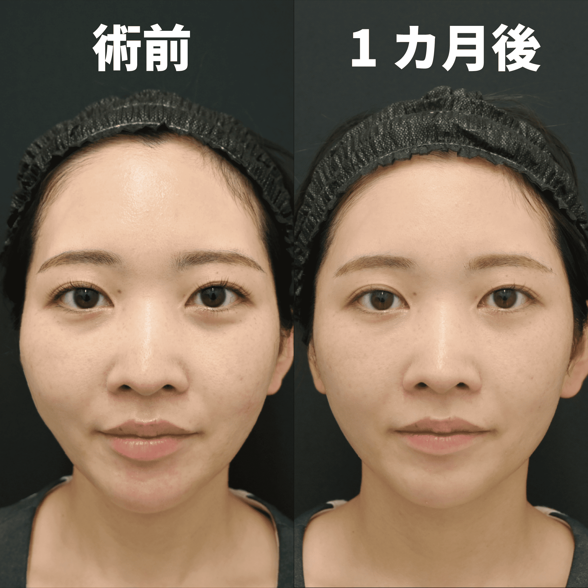 目の下のクマ・法令線の改善症例