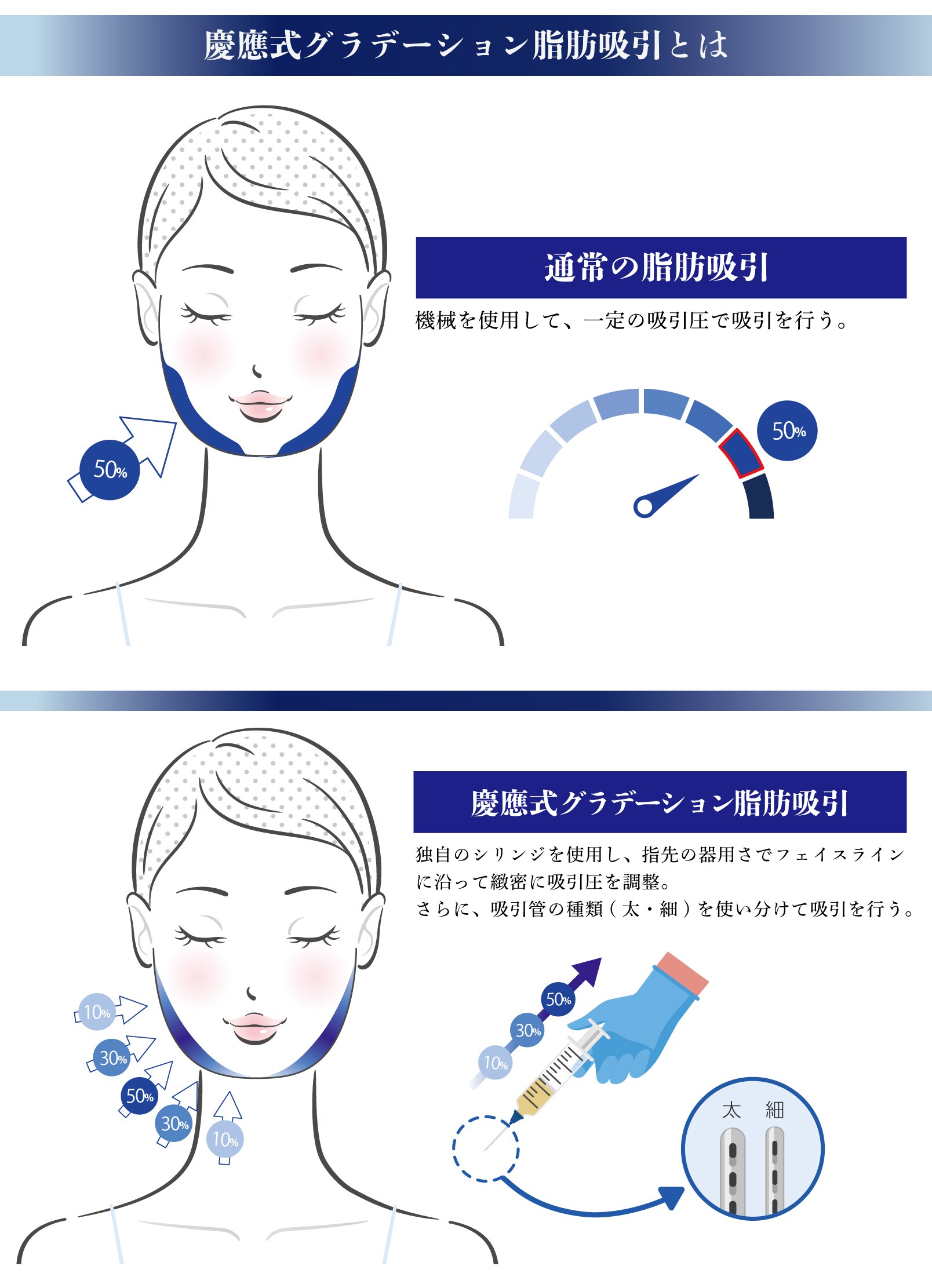 【慶応式グラデーション脂肪吸引】を徹底解説！