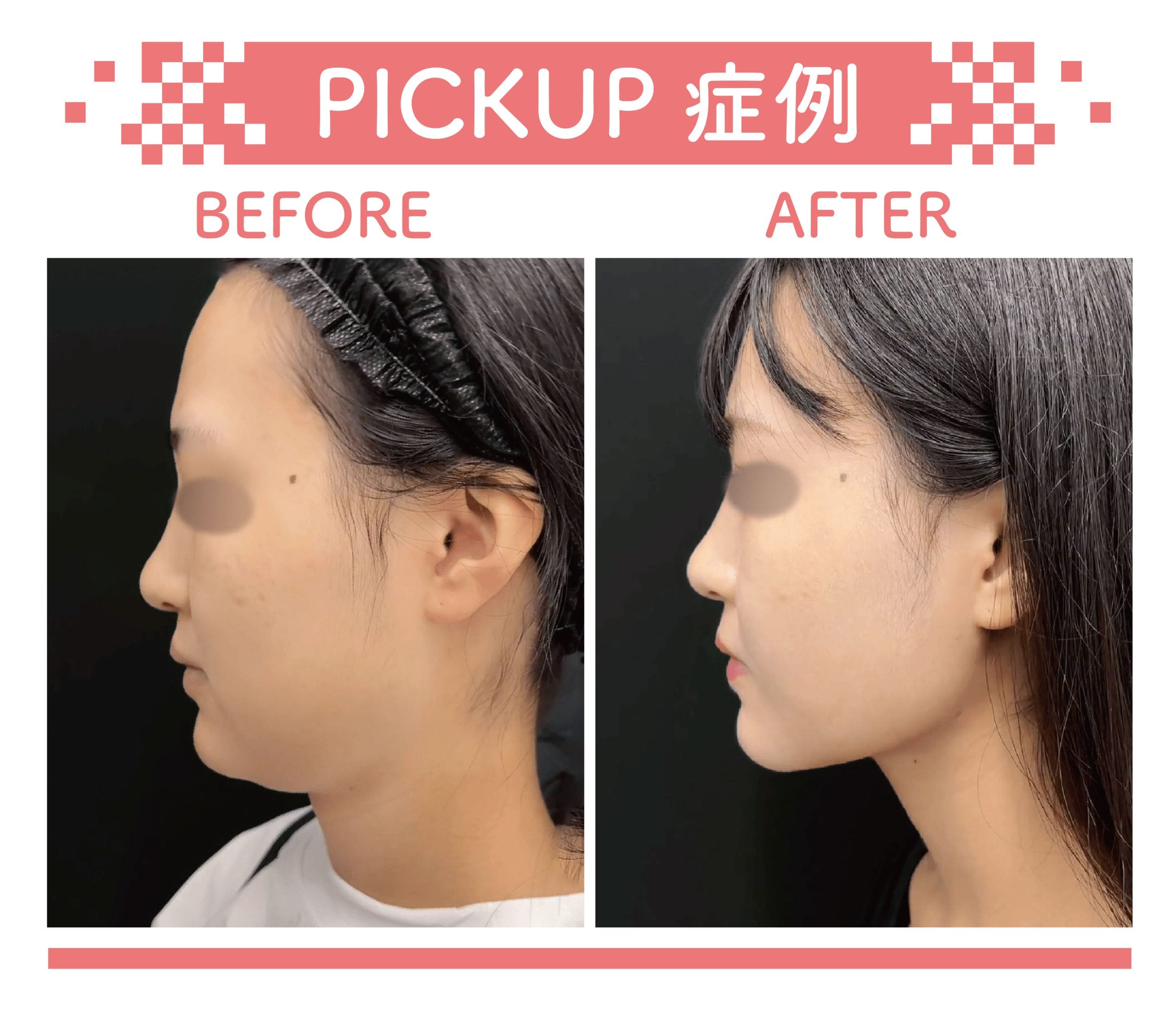 脂肪 吸引 注射
