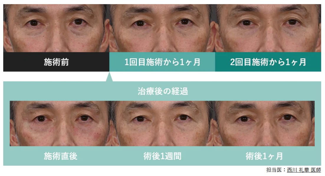 モフィウス症例