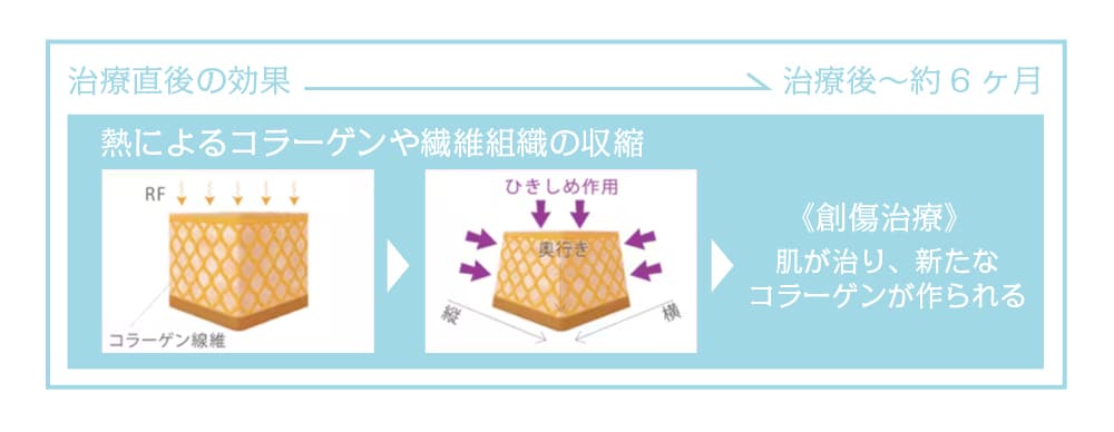 長持ちする引き締め効果! 深部からじわじわ効いてくる!?