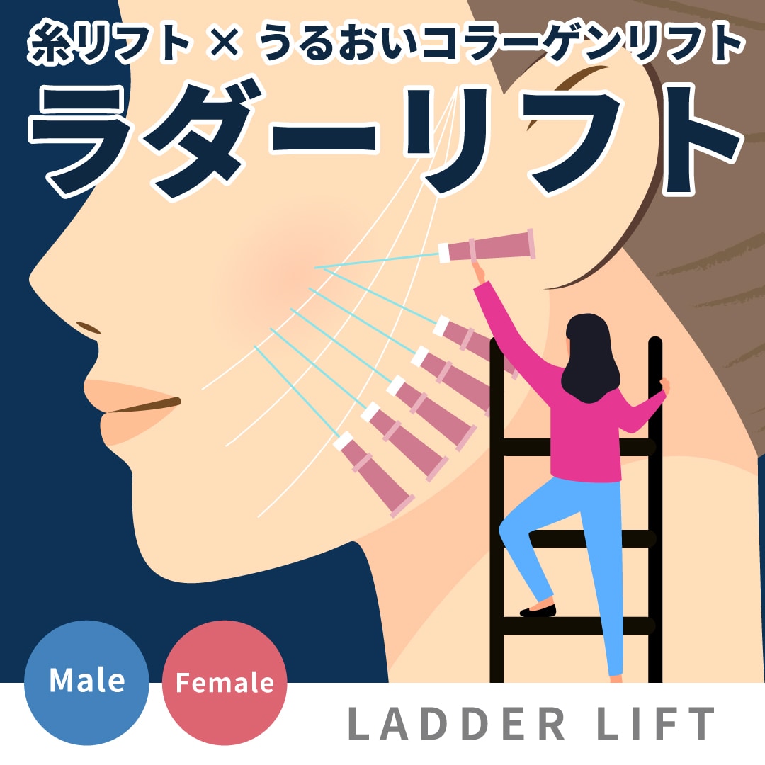 【湘南美容クリニック上野院】ラダーリフトとは？糸リフト×うるおいコラーゲンリフトで叶える“引き上げ×引き締め×小顔”の進化系スレッドリフト