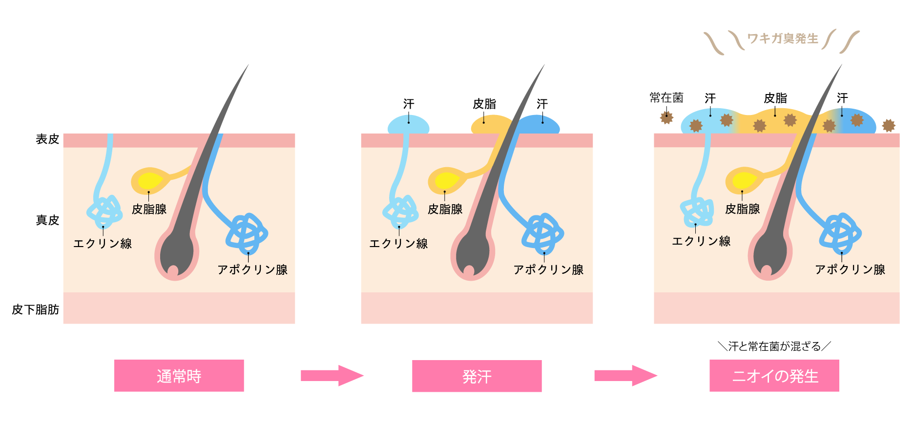 そもそもワキガの原因は・・・🫢
