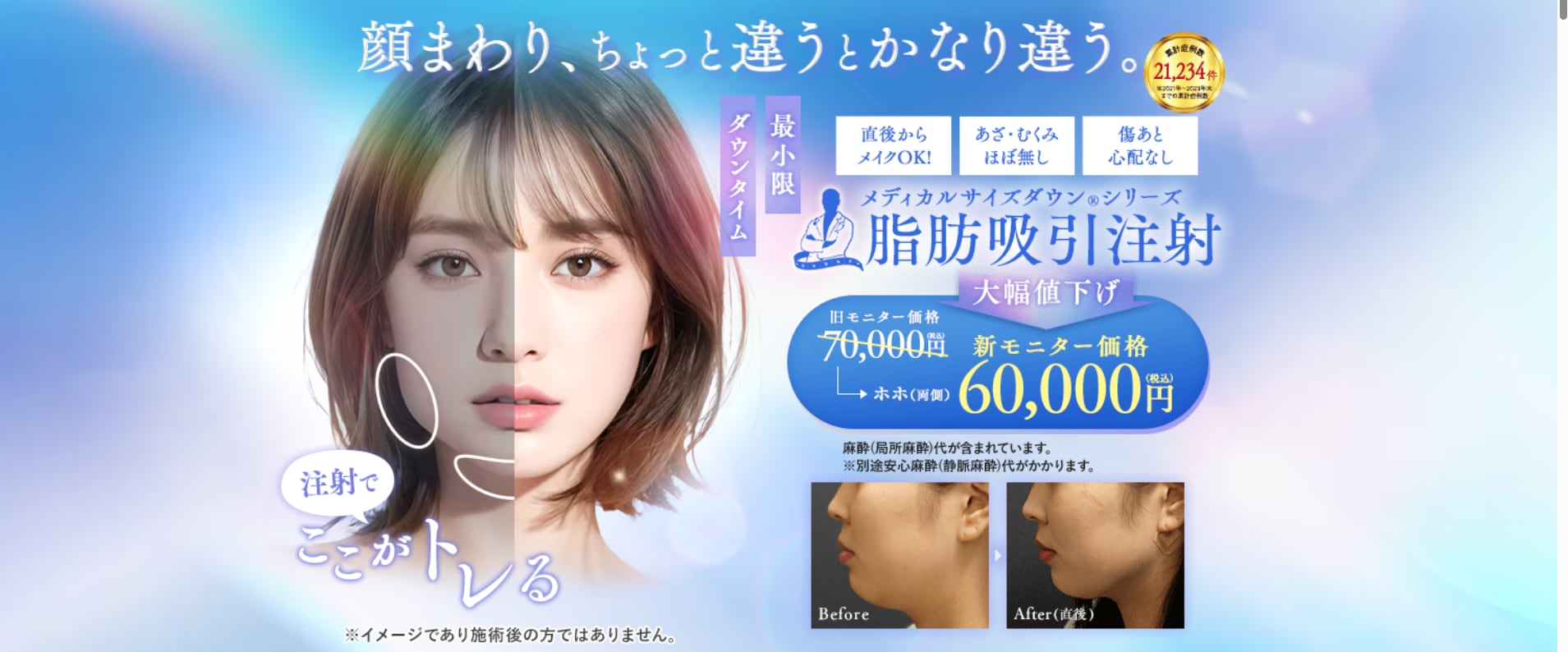 圧倒的な効果を求めるなら！究極のボディメイク「脂肪吸引」