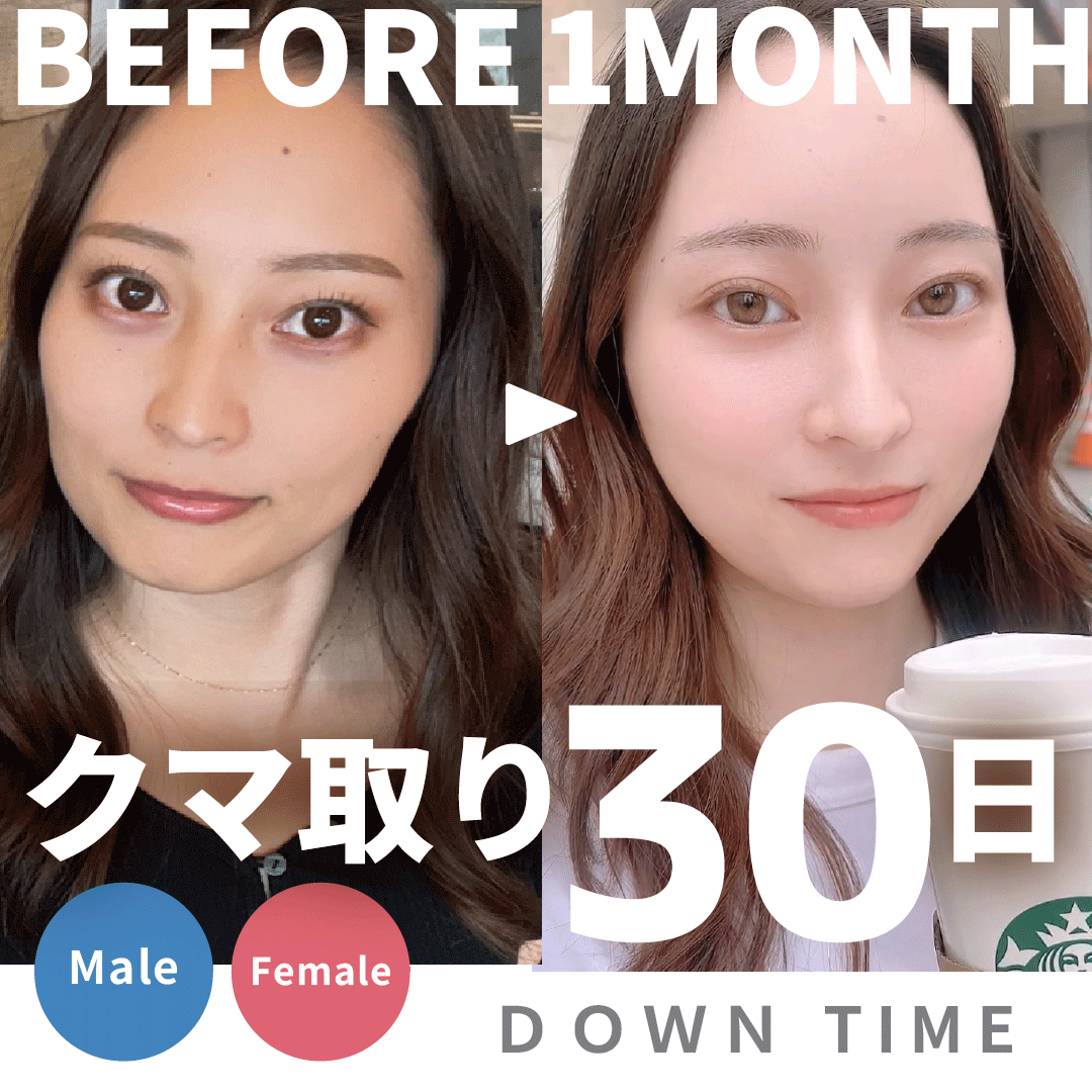 【20代のクマ取り】ダウンタイムが怖い？リアルな30日間経過レポートと後悔しないためのクマ取り全知識【完全保存版】