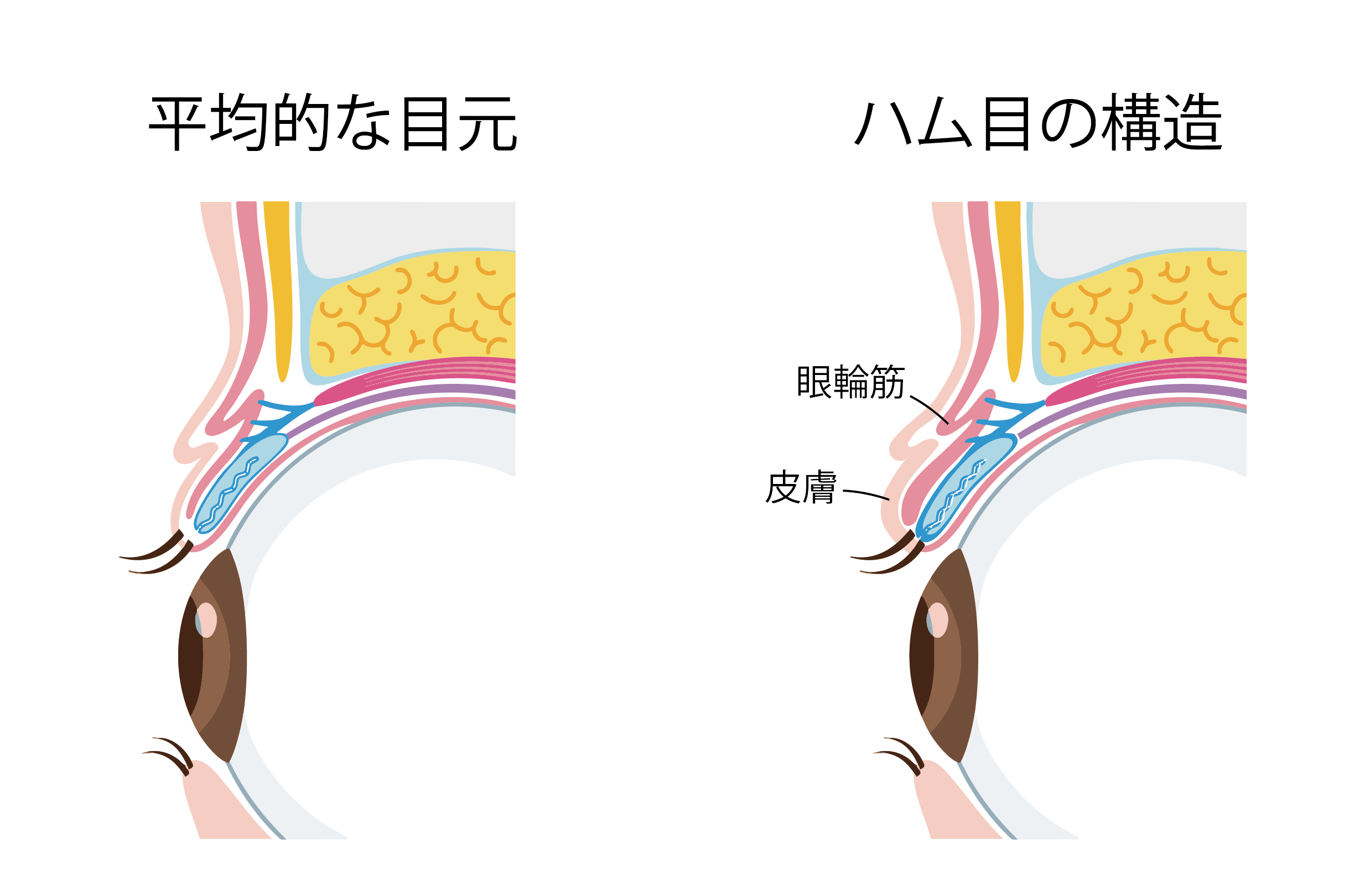 ハム目の原因を示すイメージ画像