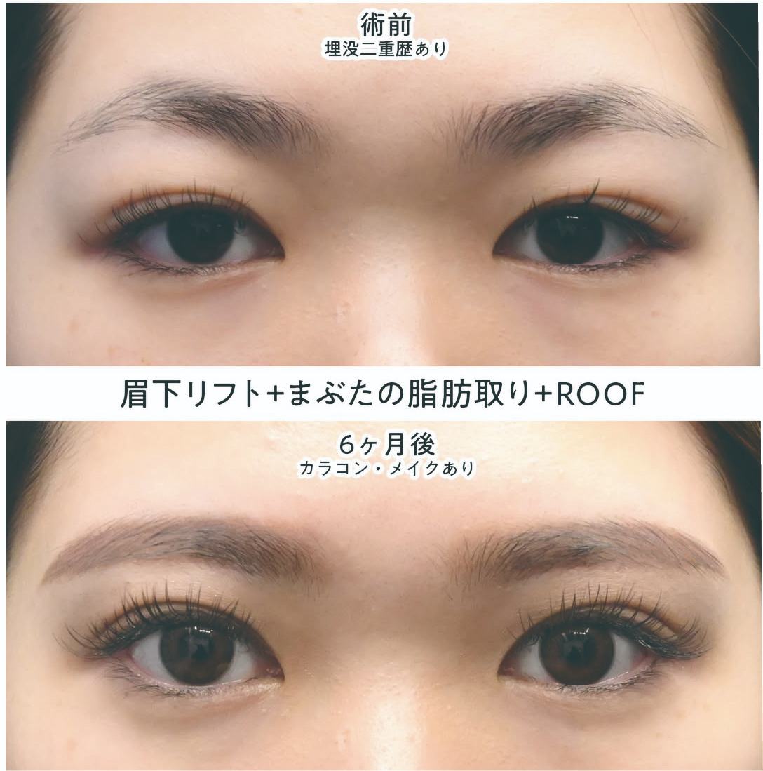 眉下切開の症例