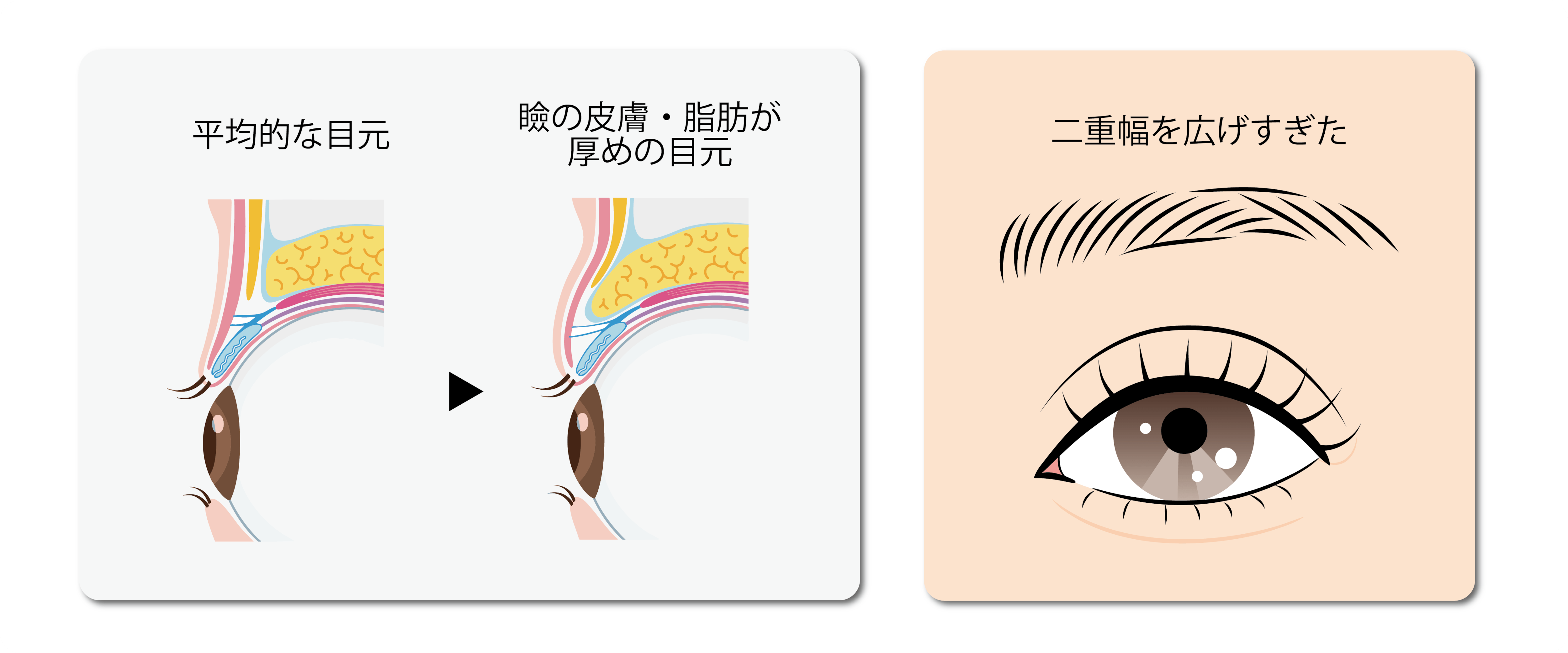 ハム目になりやすい人の特徴を示すイメージ画像