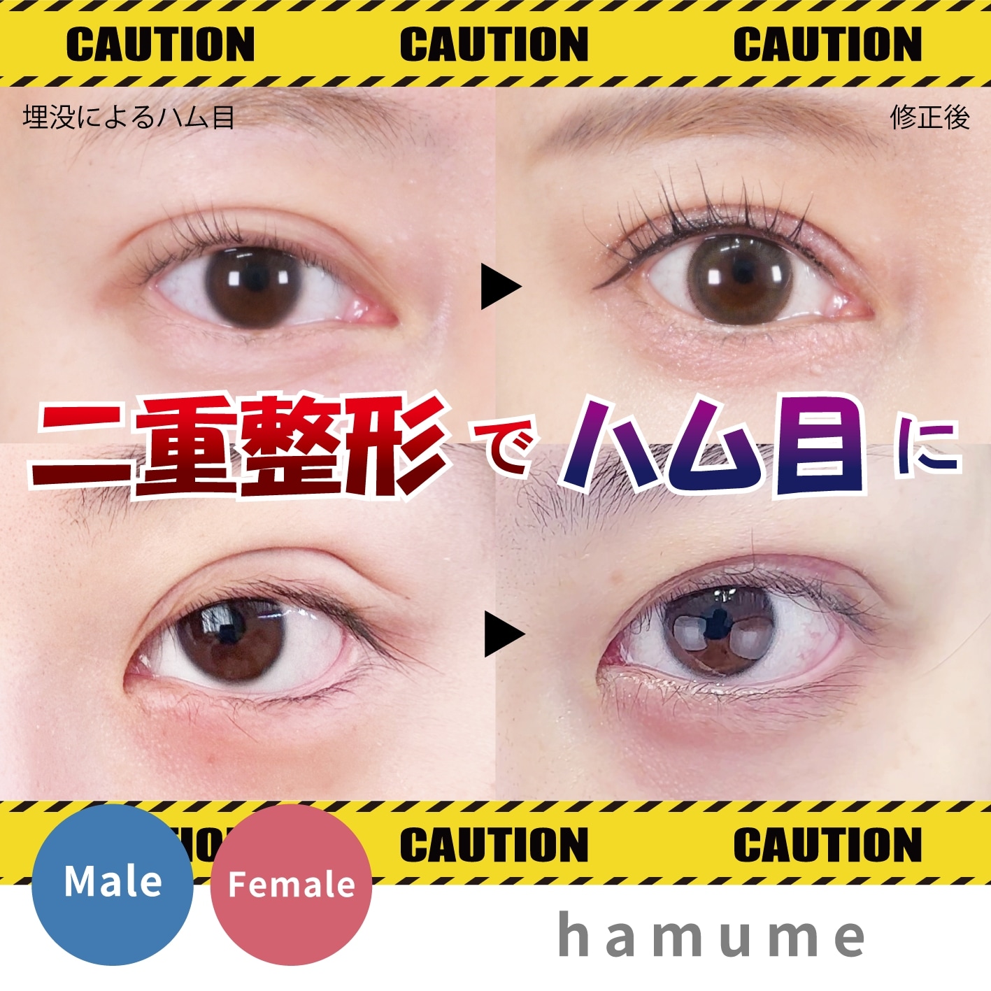 【二重にしたい人は絶対見て！】埋没法・全切開法で「ハム目」にならないようにするには？誰でも起こりうる「ハム目」、きちんと理解していますか？