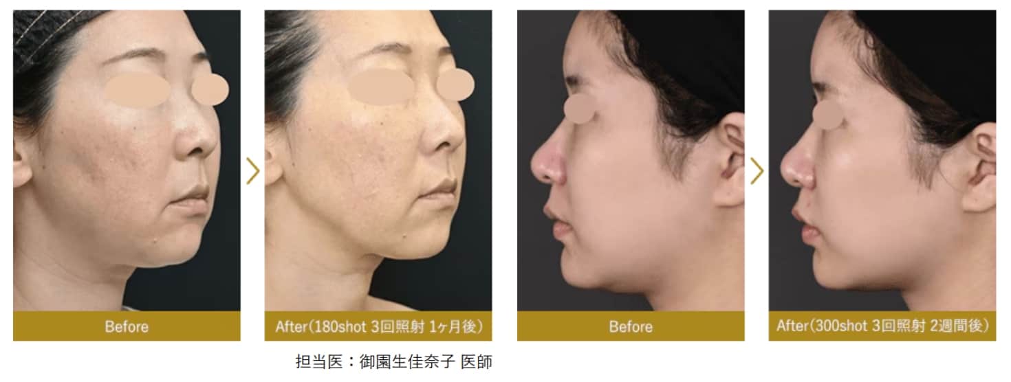 ゲリラキャンペーン