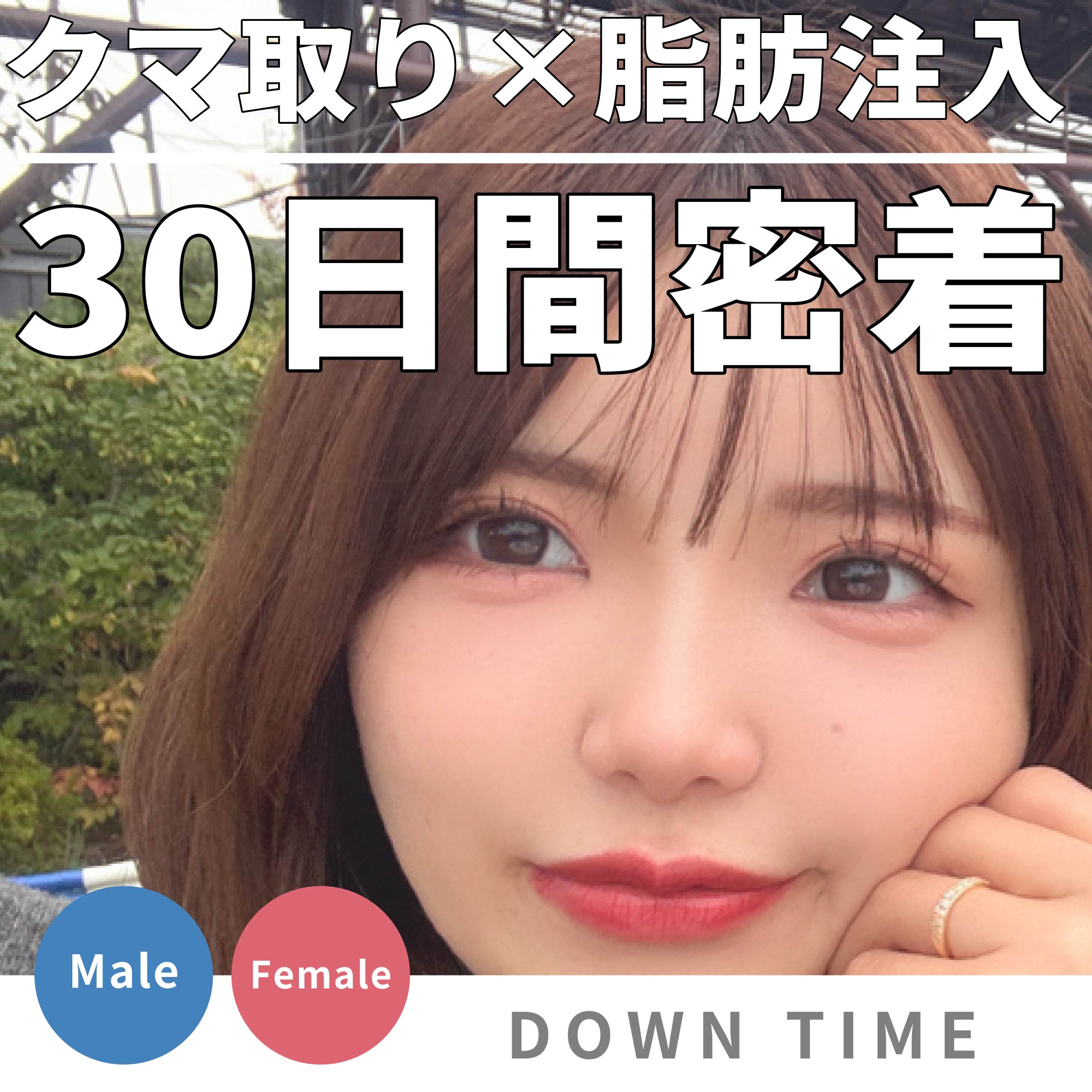 【写真あり】クマ取りダウンタイム30日間完全密着!腫れのピークや仕事復帰はいつ?