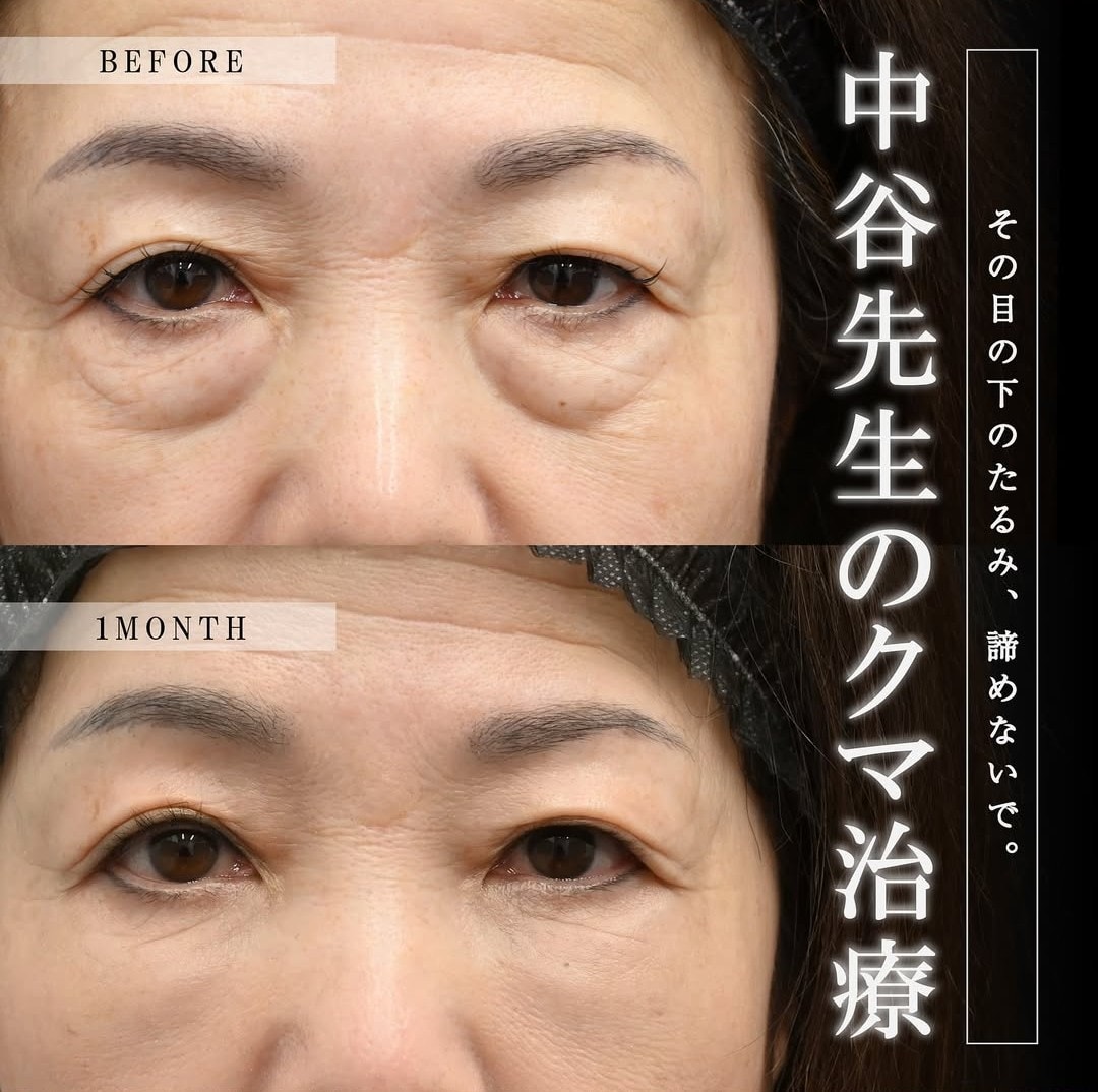 上野院中谷医師のクマの症例