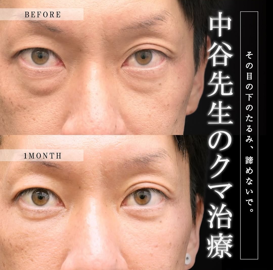 上野院中谷医師のクマの症例