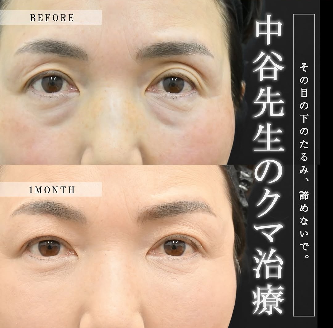 上野院中谷医師のクマの症例