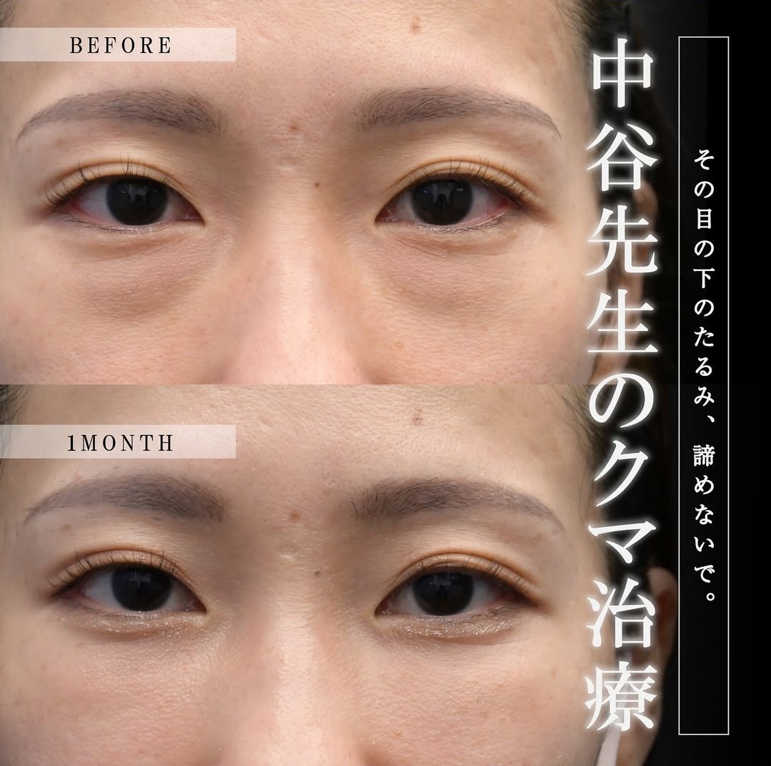 上野院中谷医師のクマの症例