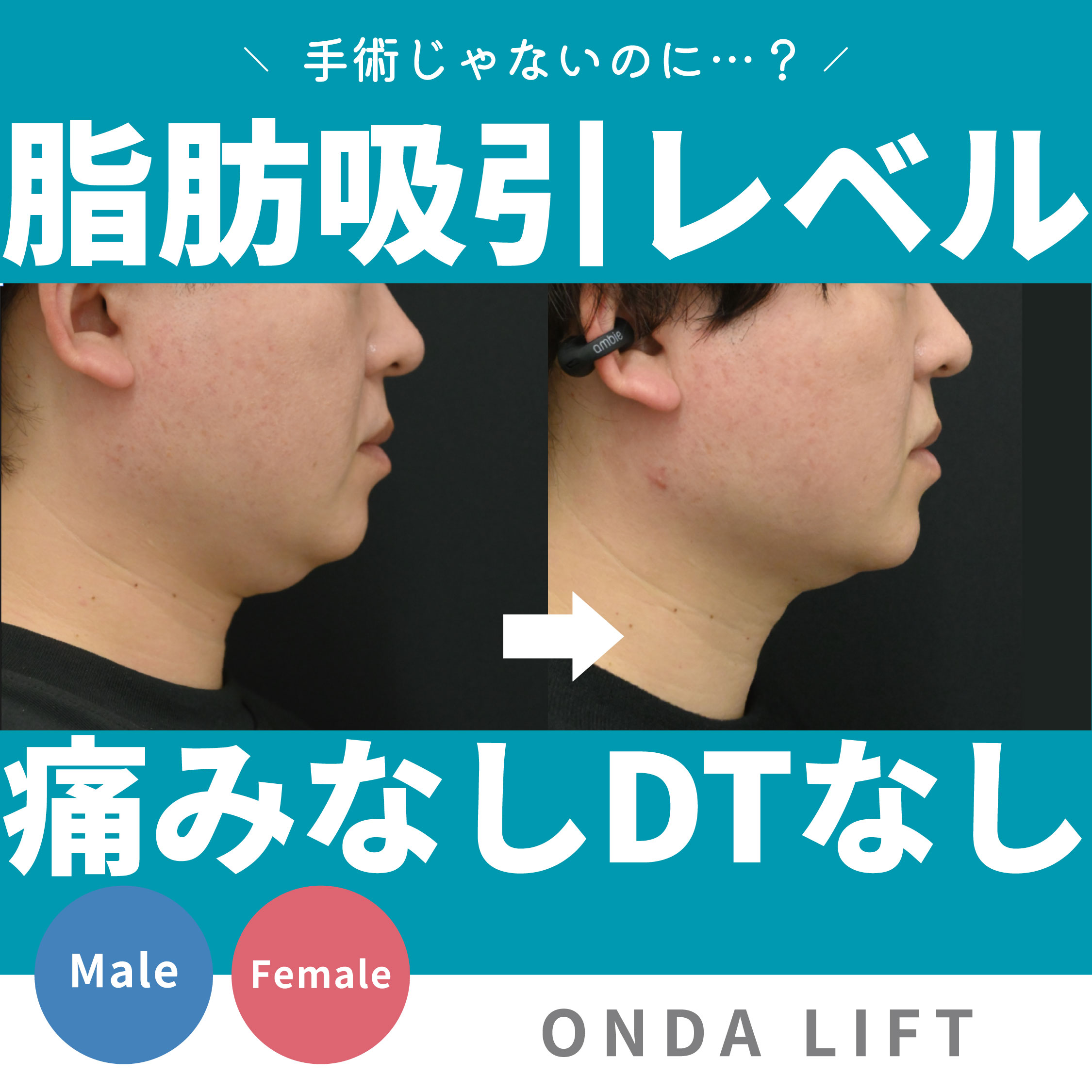 オンダリフトは効果なし?「痛くない」は本当か、ハイフ民が実際に検証してみた。