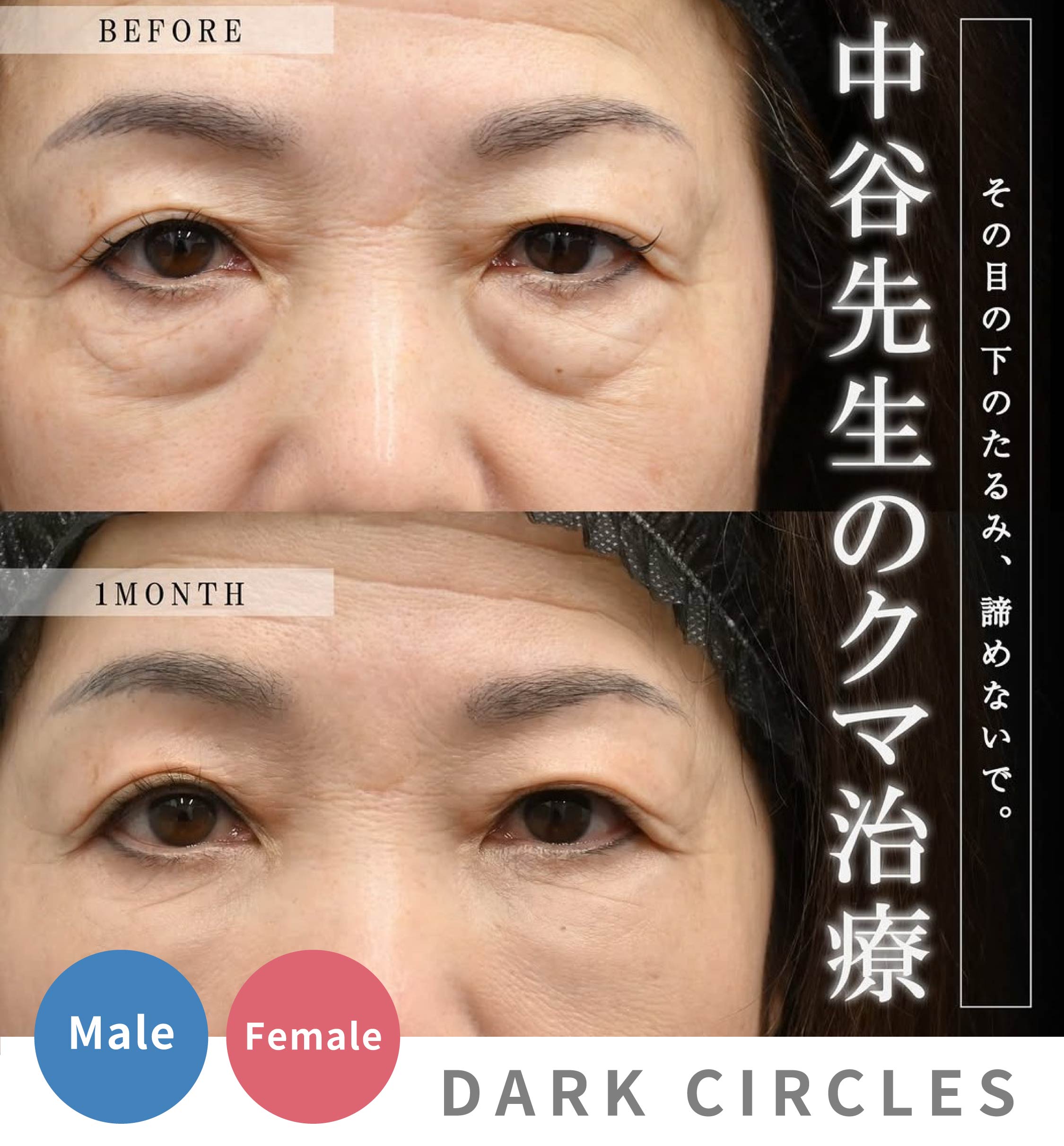 【永久保存版】湘南美容クリニック中谷拓医師の「クマ取り」症例一挙公開!なぜ指名が殺到するのか?