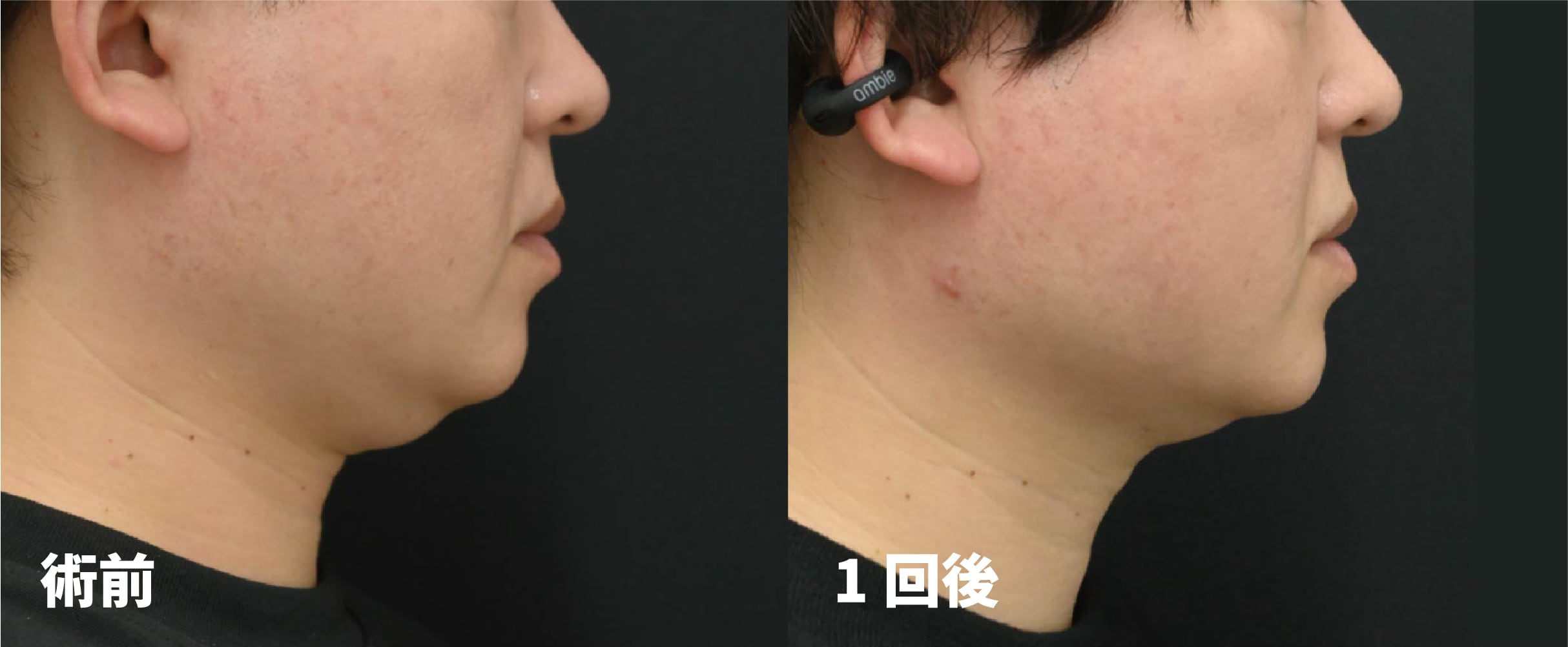 [オンダリフト（フェイス）症例]