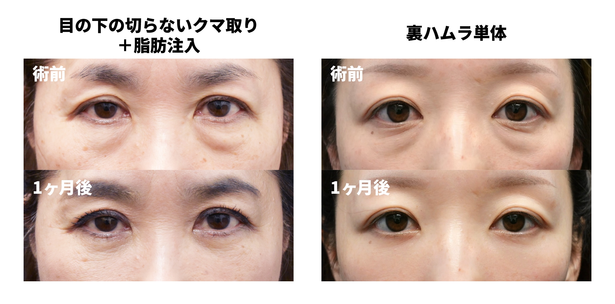 [目の下のクマ治療 症例]