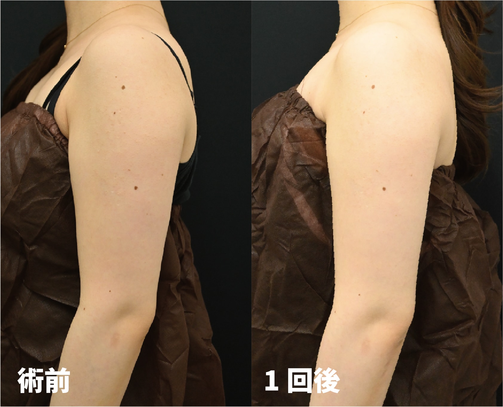 [オンダリフト（二の腕）症例]