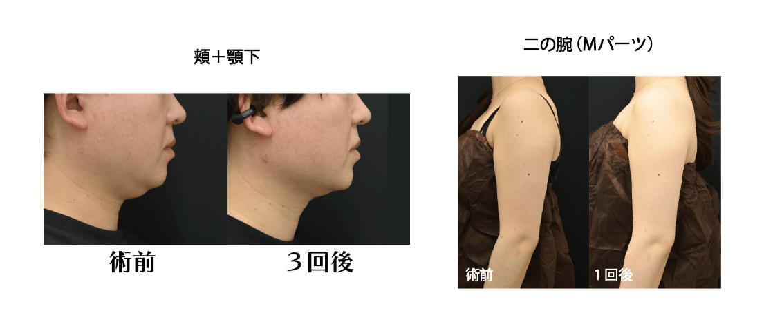 オンダリフト 2