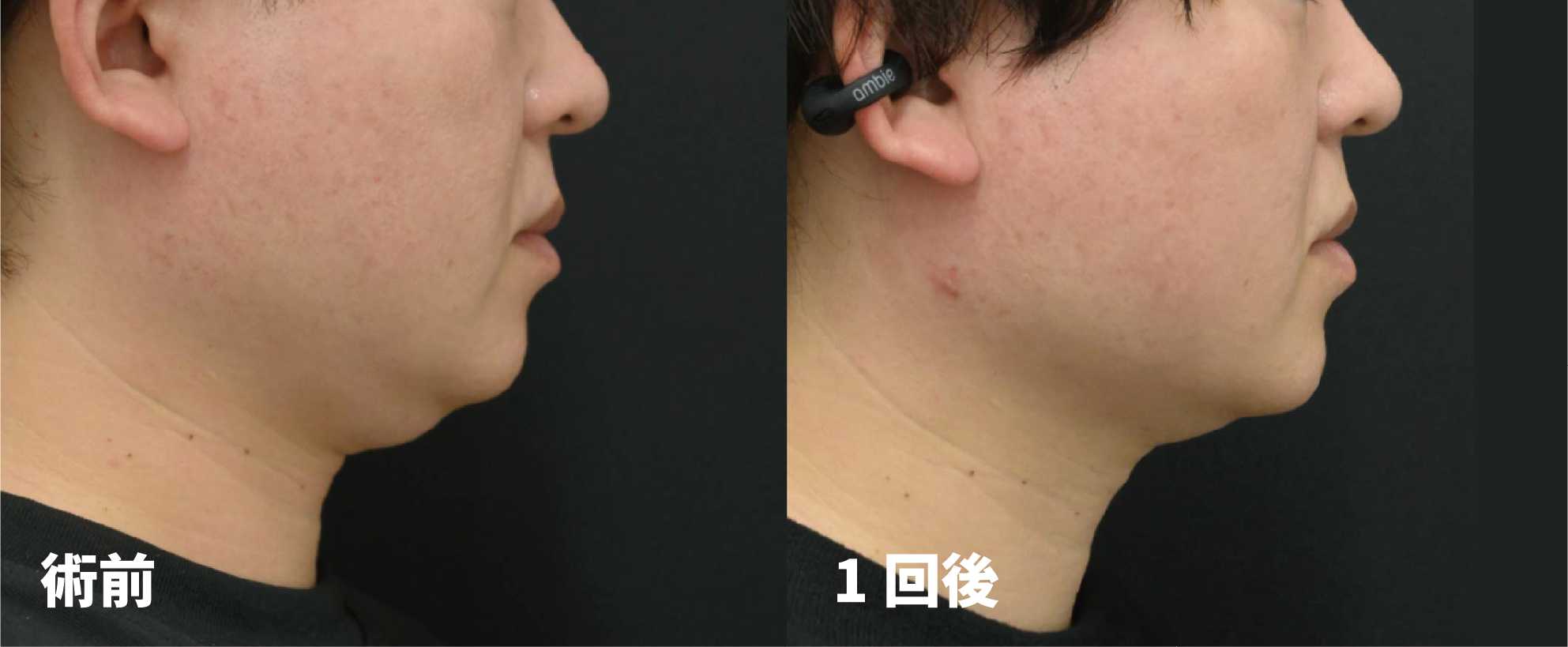 オンダリフト症例1