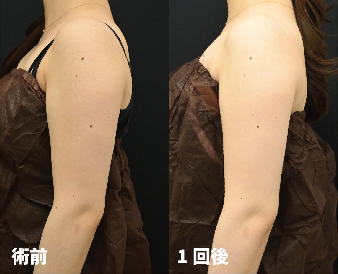 オンダリフト症例2