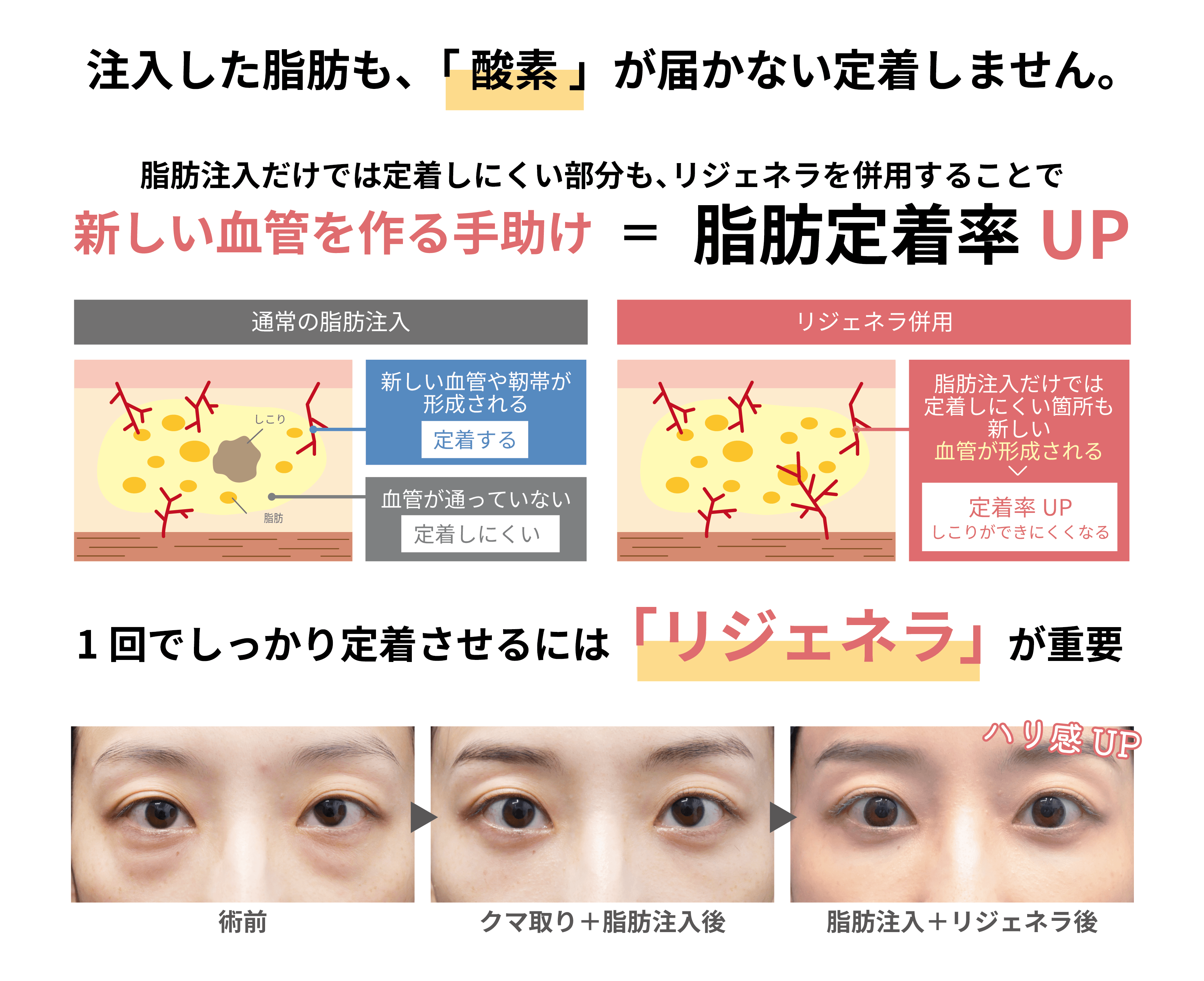 リジェネラなぜ必要？