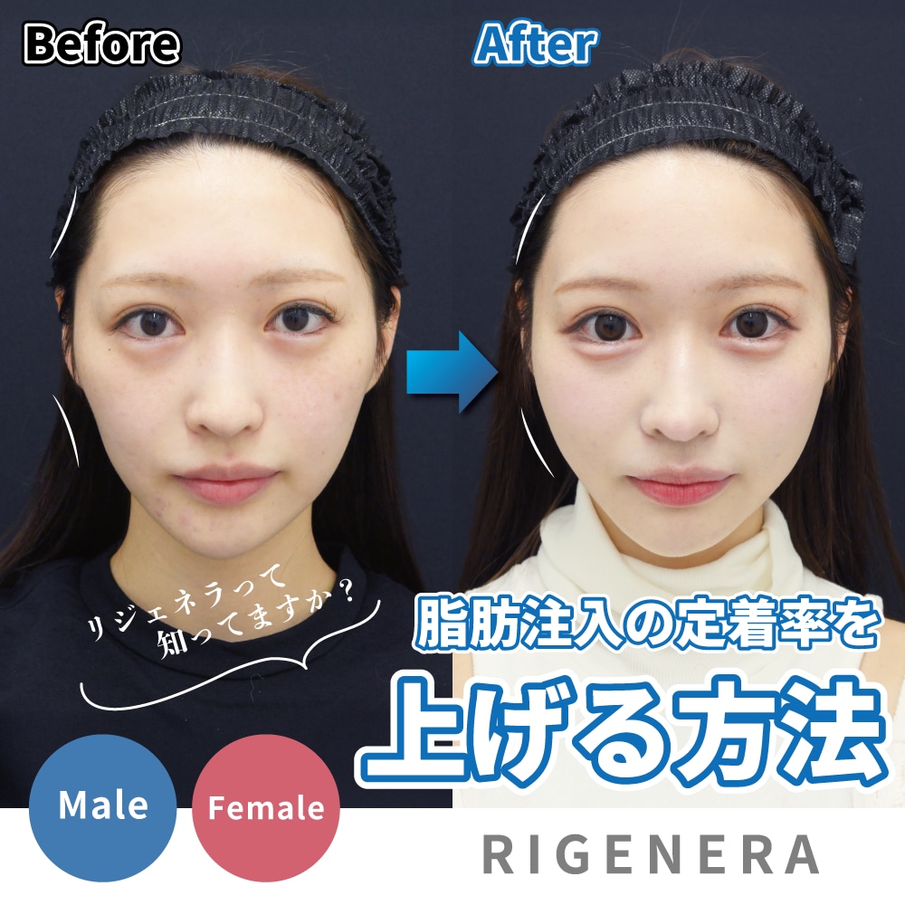 脂肪注入の定着率を大幅アップさせる方法｜再生医療『リジェネラ』がカギ🗝️