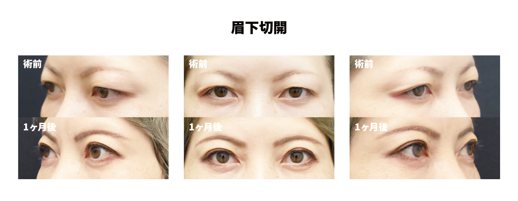 眉下症例