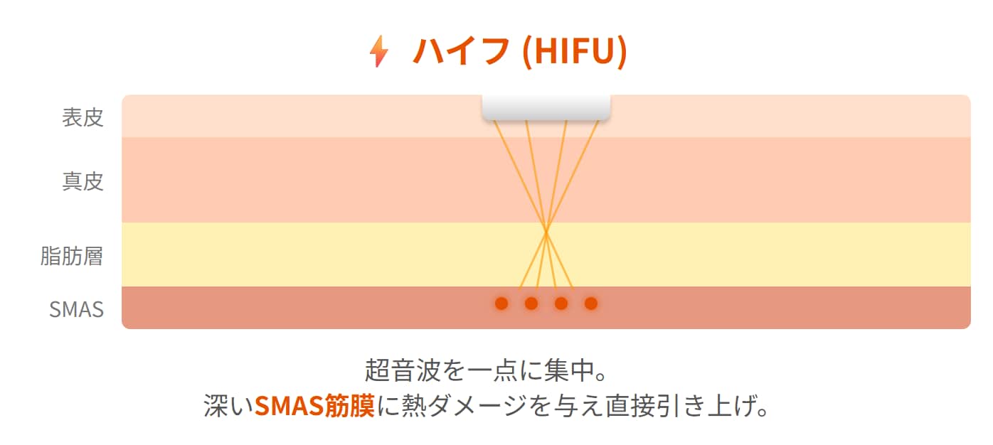 ハイフの照射範囲
