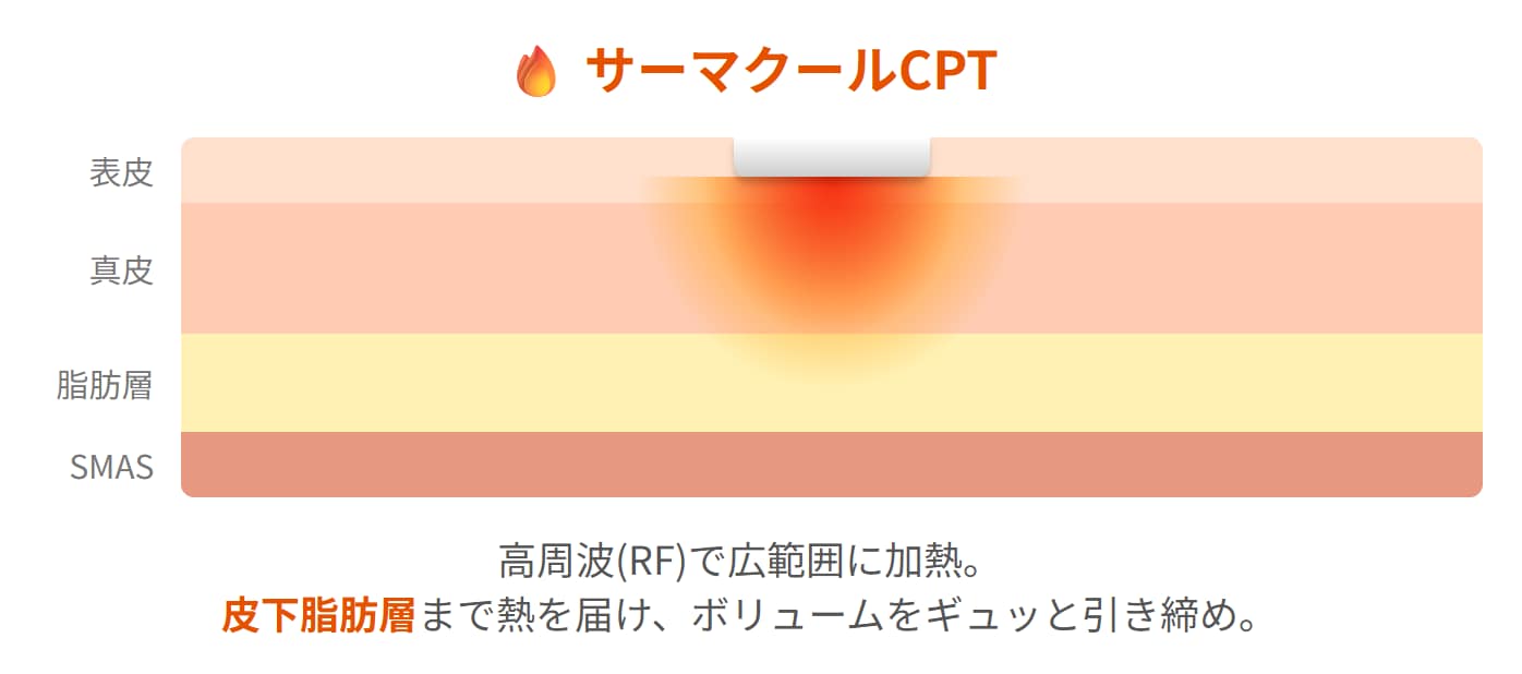 サーマクールCPTの照射範囲
