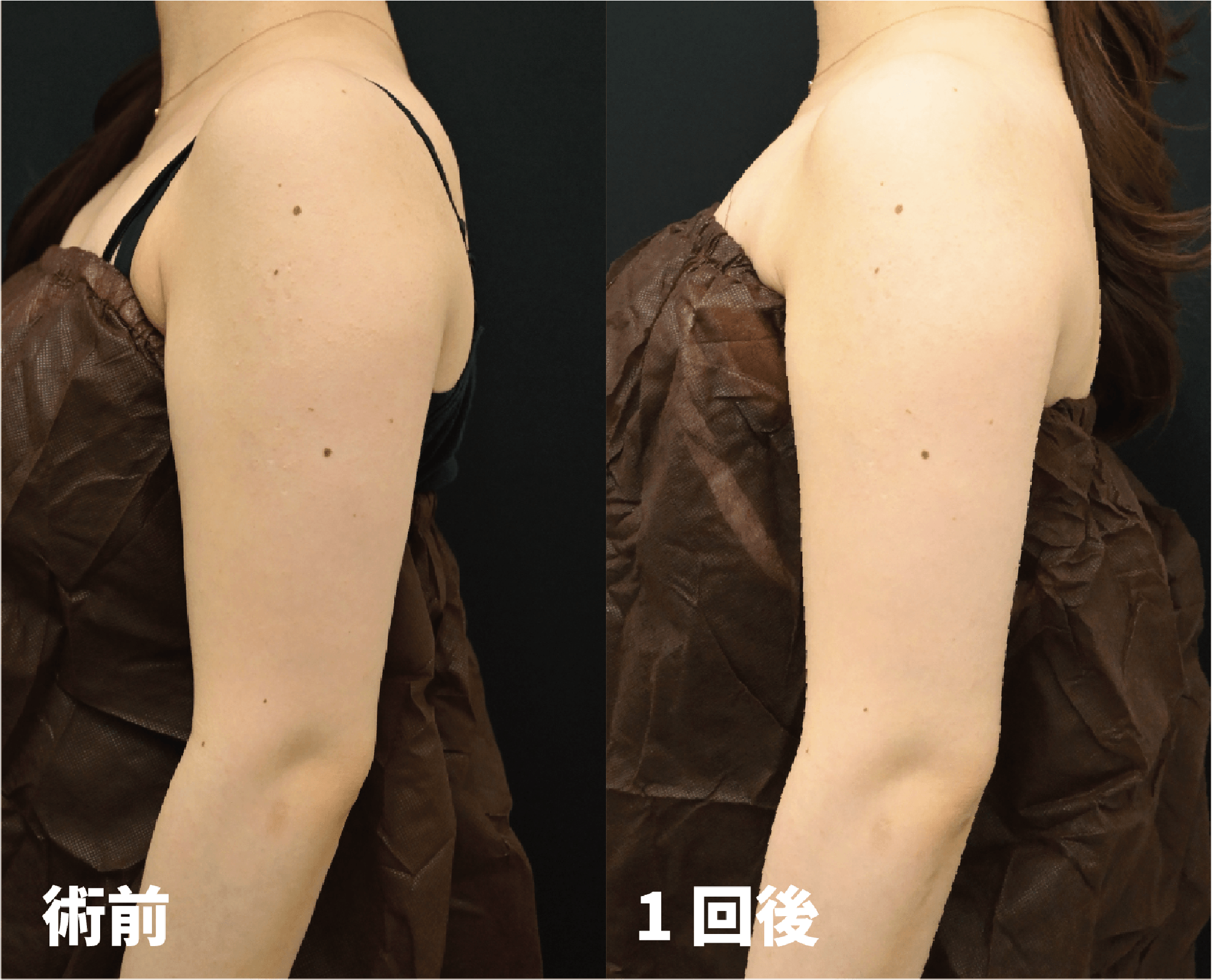 オンダ症例(二の腕)