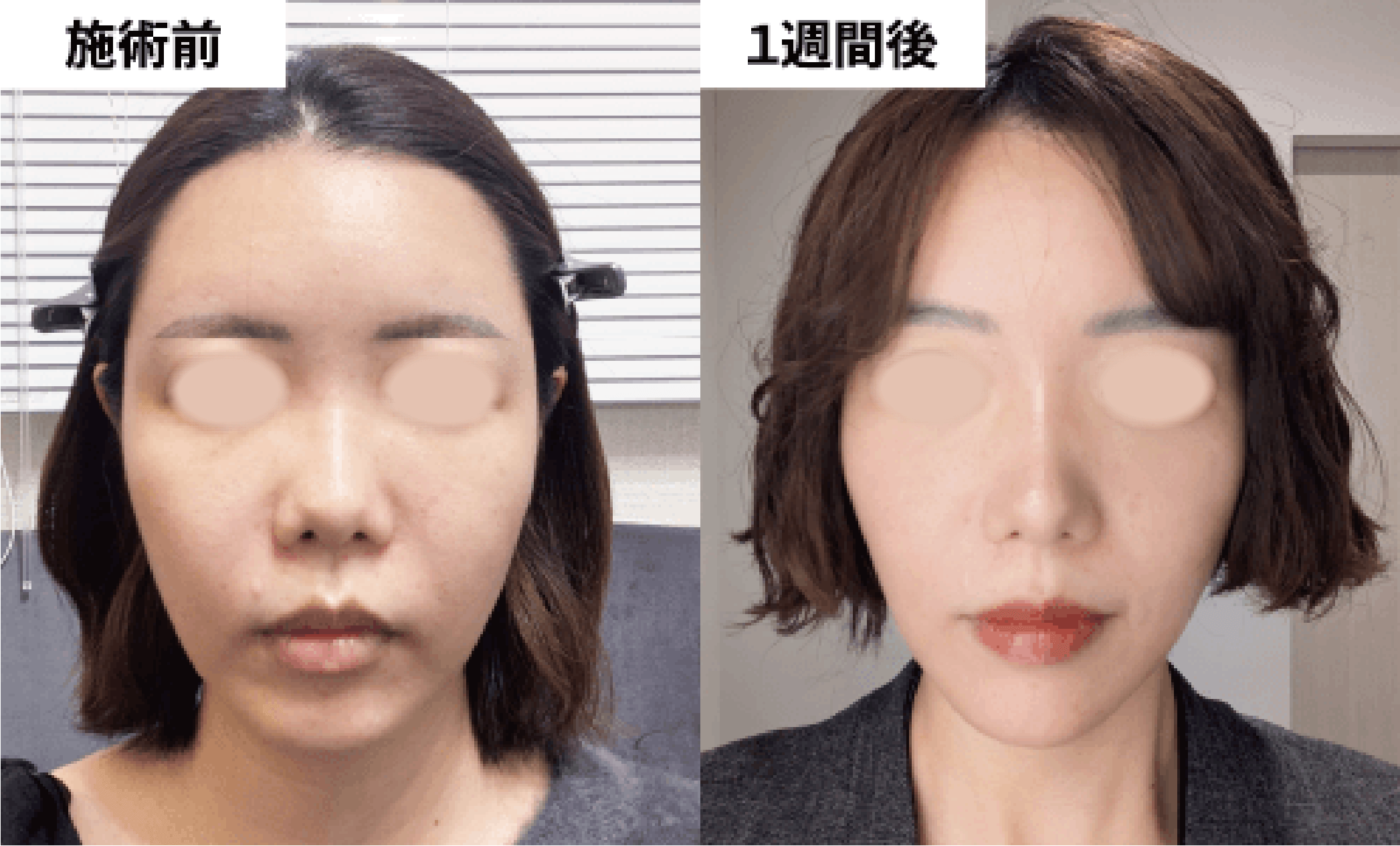 デンシティ症例