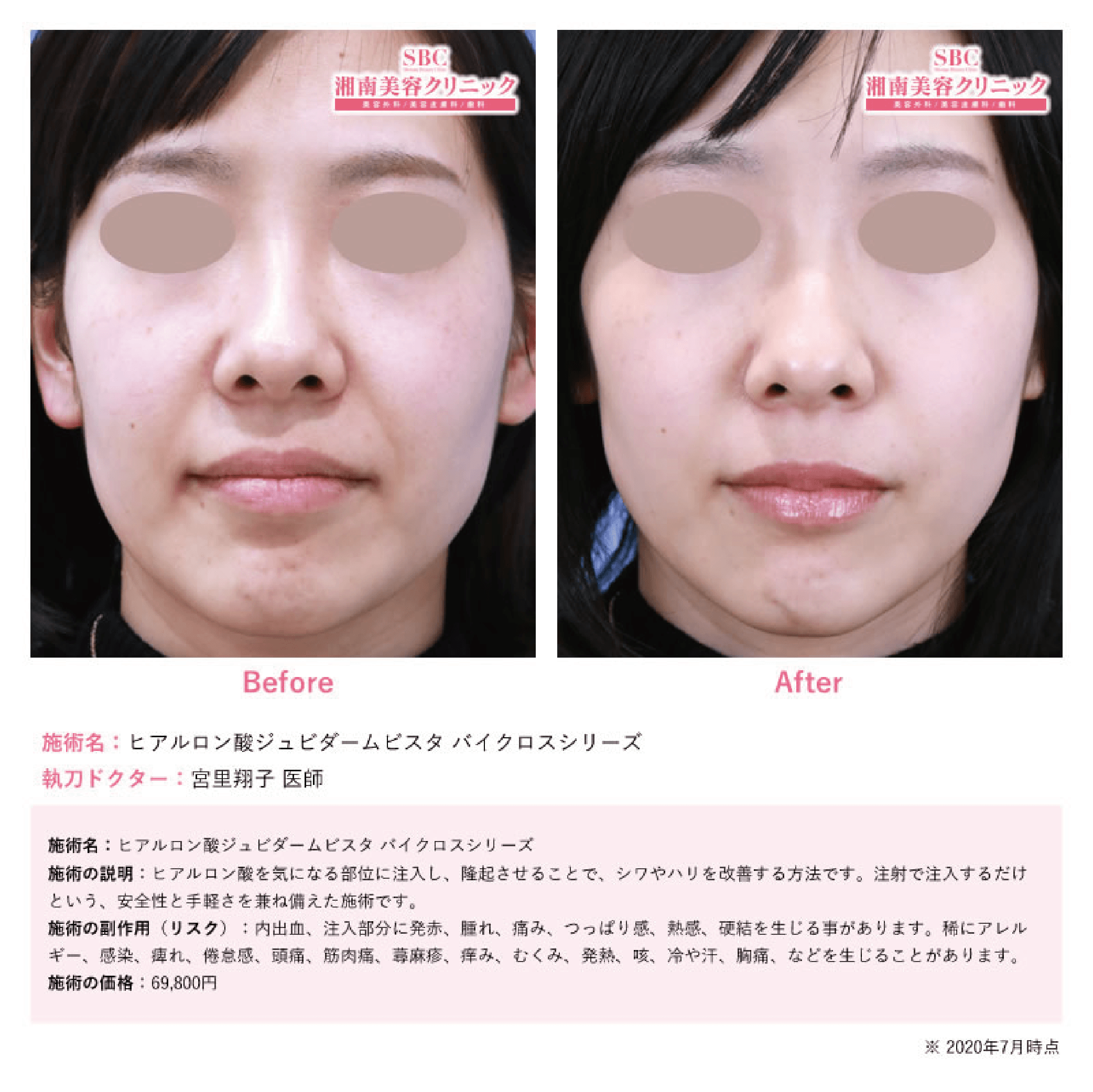 ヒアルロン酸症例