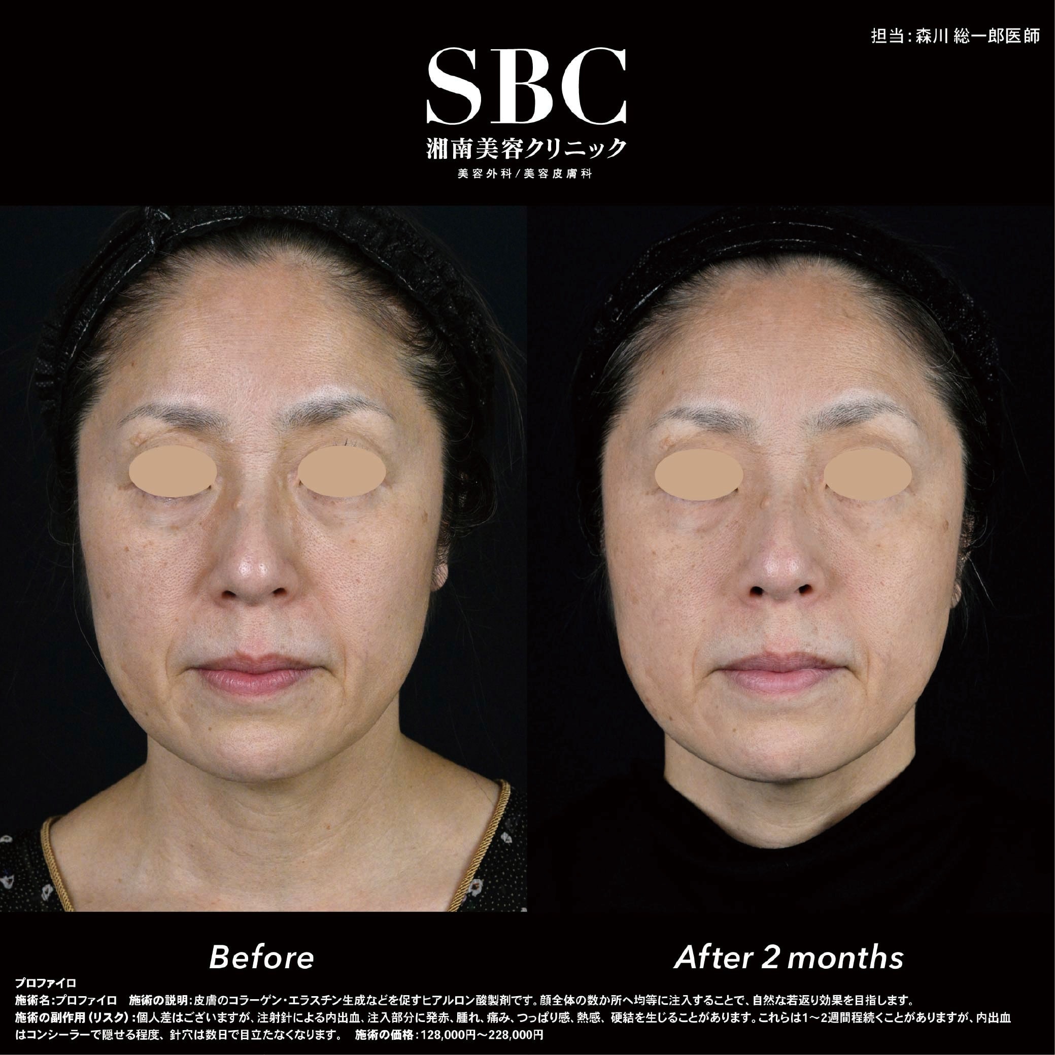 プロファイロ症例