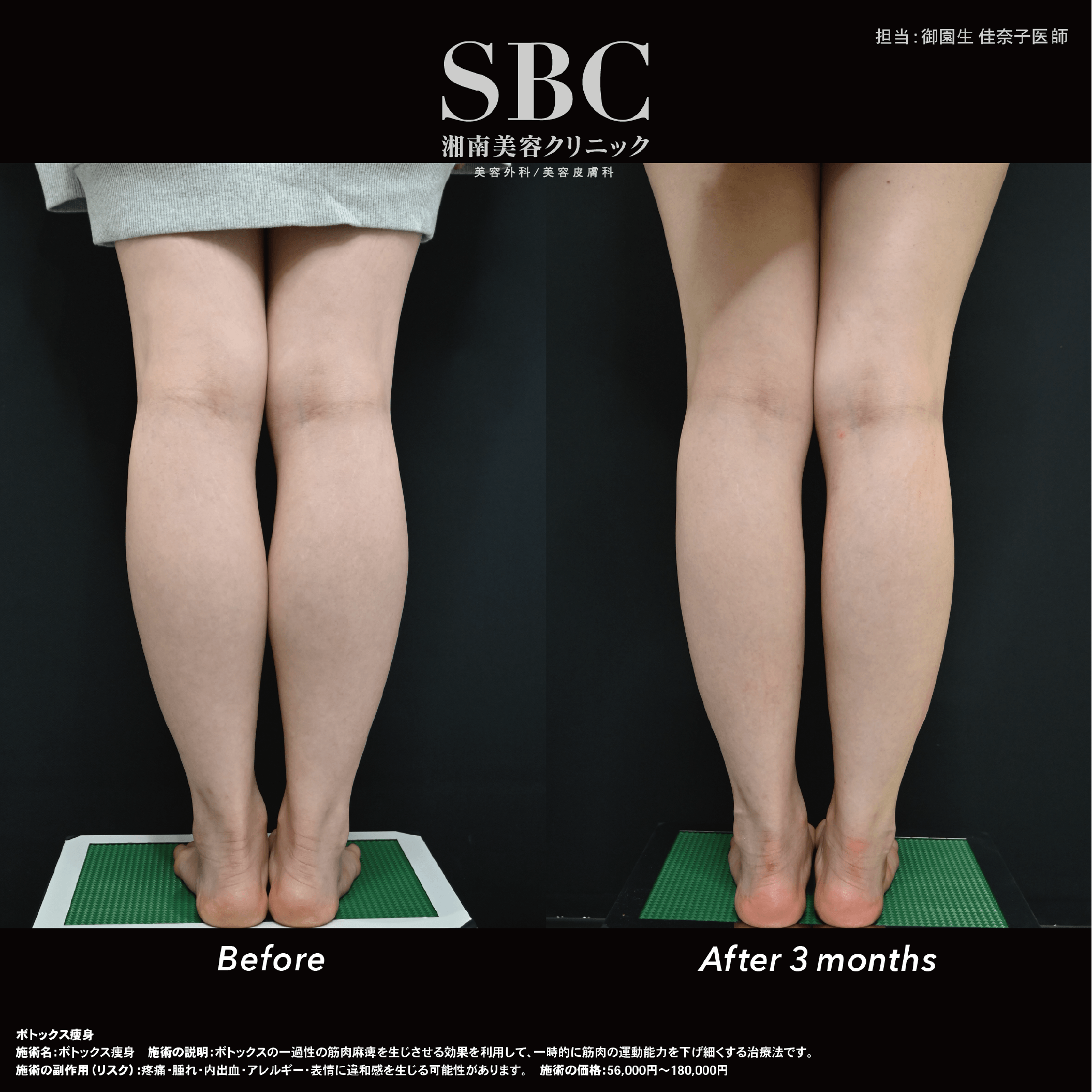 下腿ボトックス症例