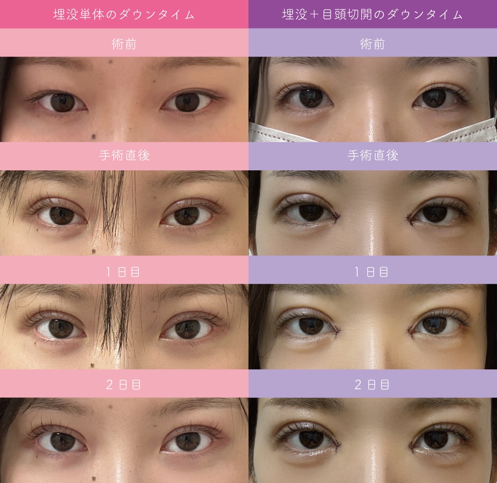 術前〜2日比較