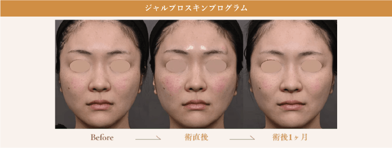 ジャルプロスキンプログラム症例