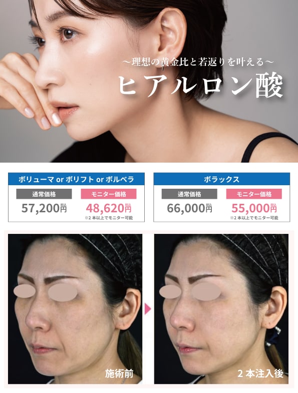 ヒアルロン酸