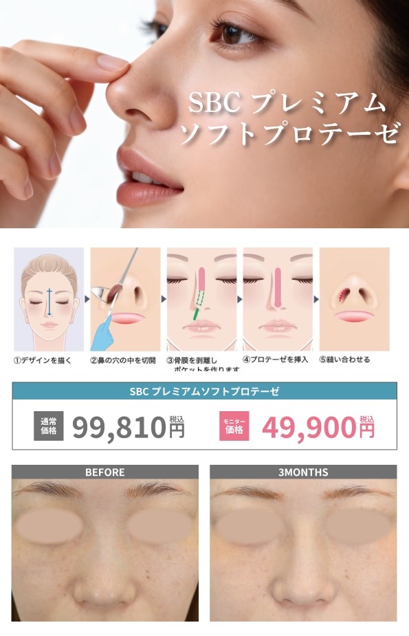 プロテーゼ