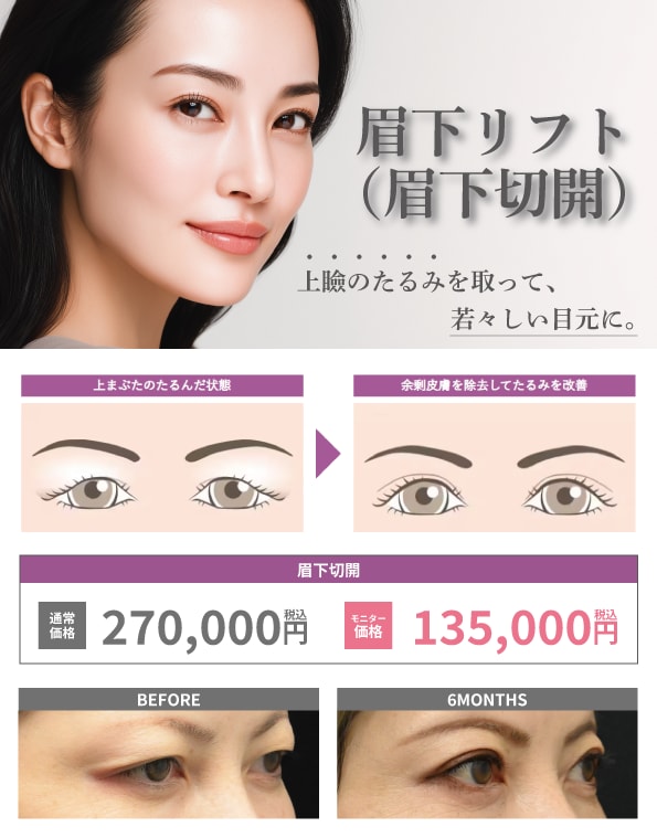 眉下切開