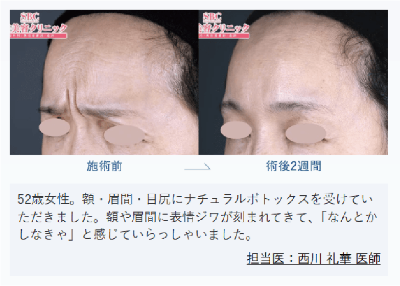 アラガンボトックス症例