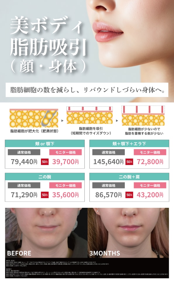 脂肪吸引