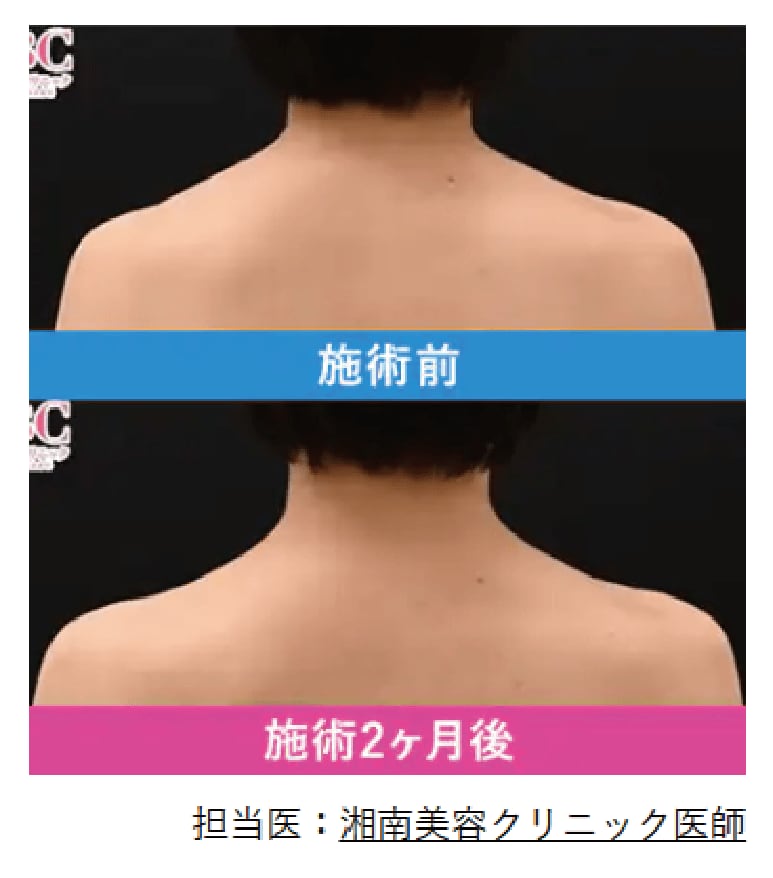 肩ボトックス症例