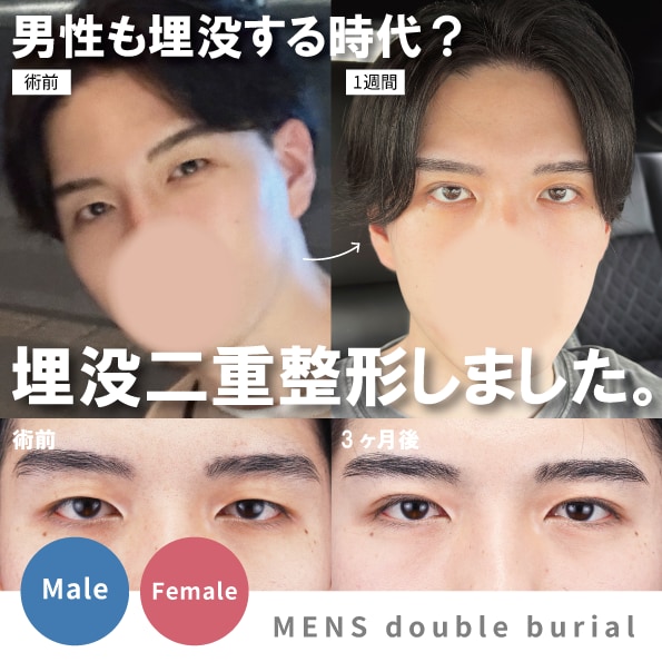 東京・上野で男性の二重整形（埋没法）なら湘南美容クリニック上野院